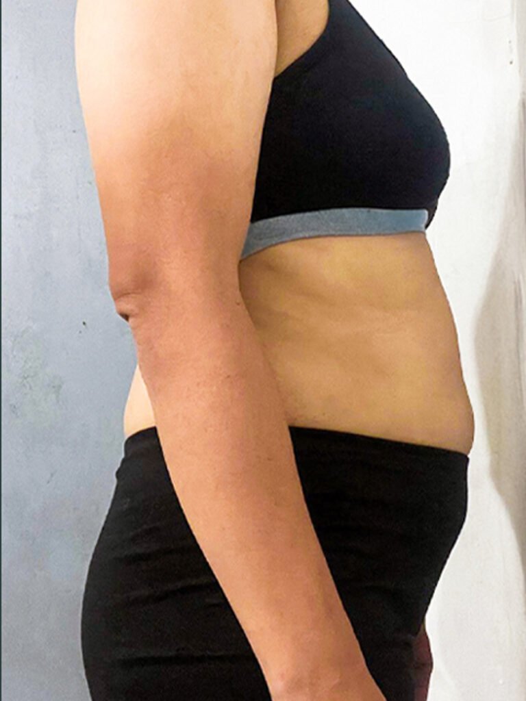 Before weight loss results using GLP-1 peptide therapy in the Philippines - Cheska